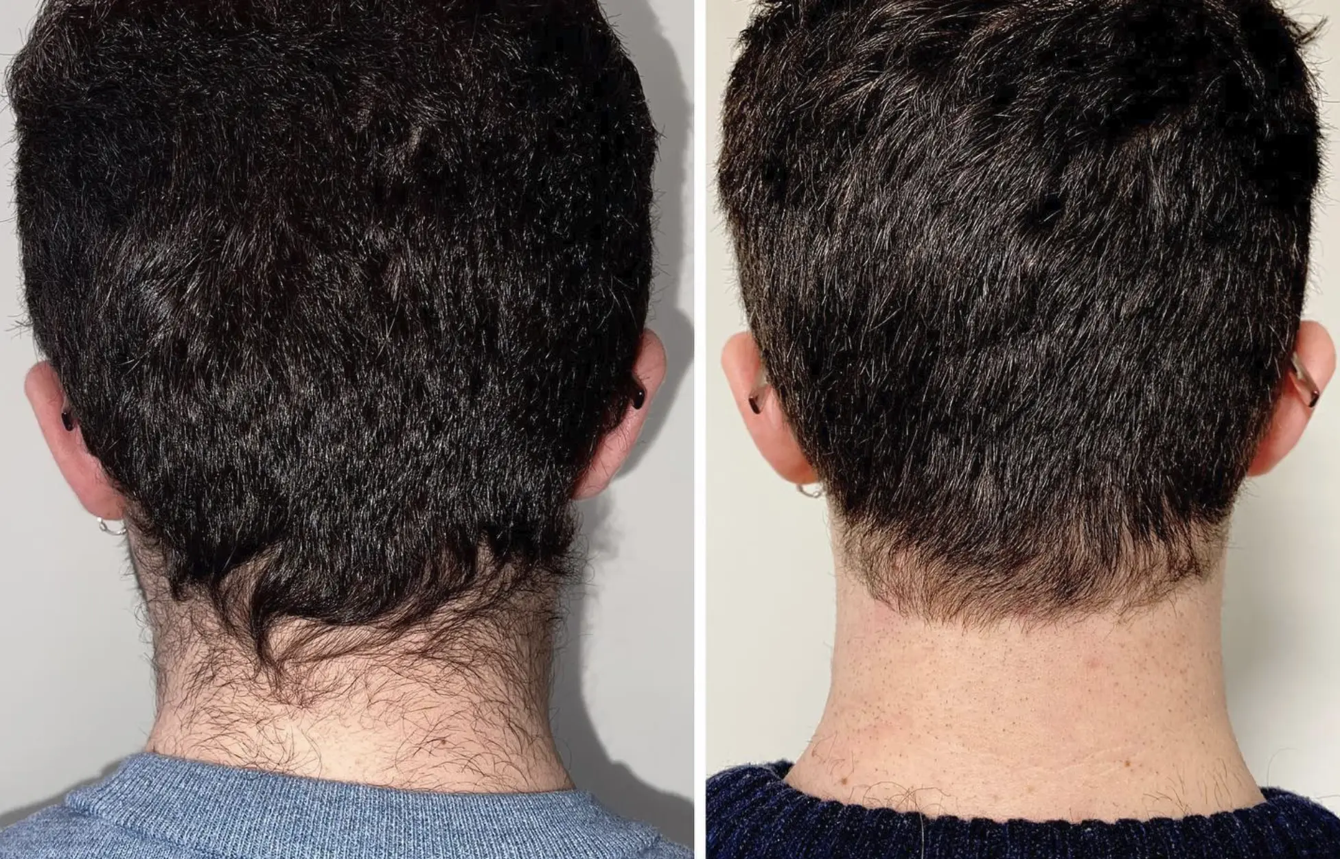 dailysoccerblog | Should Laser Practitioners Learn Male-Specific Techniques? dailysoccerblog | Should Laser Practitioners Learn Male-Specific Techniques?